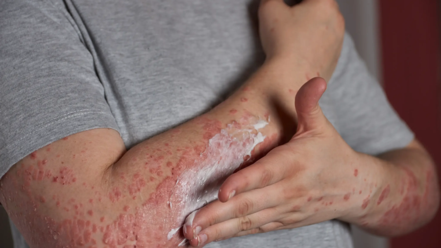 applying-moisturizer-skin-with-psoriasis
